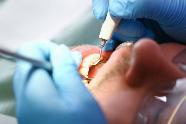 Best Emergency Root Canal Treatment in Rensselaer, IN