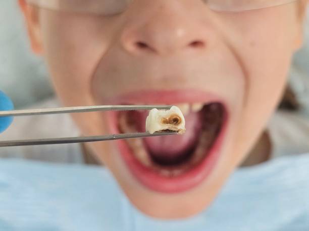 Best Emergency Dental Care for Abscessed Tooth in Rensselaer, IN